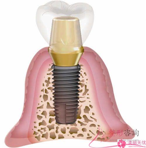 種植牙是啥與普遍價格