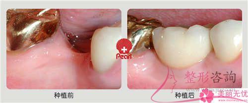 種植牙是啥與普遍價格