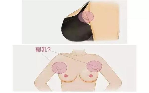 副乳切除手術多久恢復