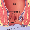  痔瘡手術(shù)疼么