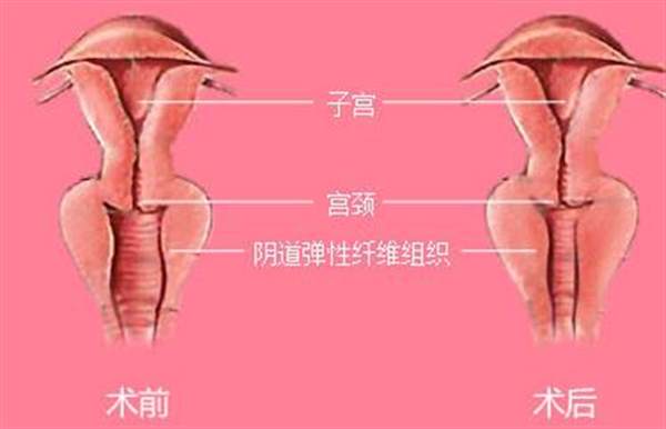 陰部整形前后對比