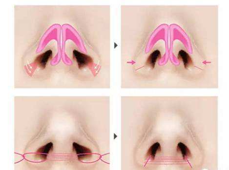 如何讓鼻孔變小一點